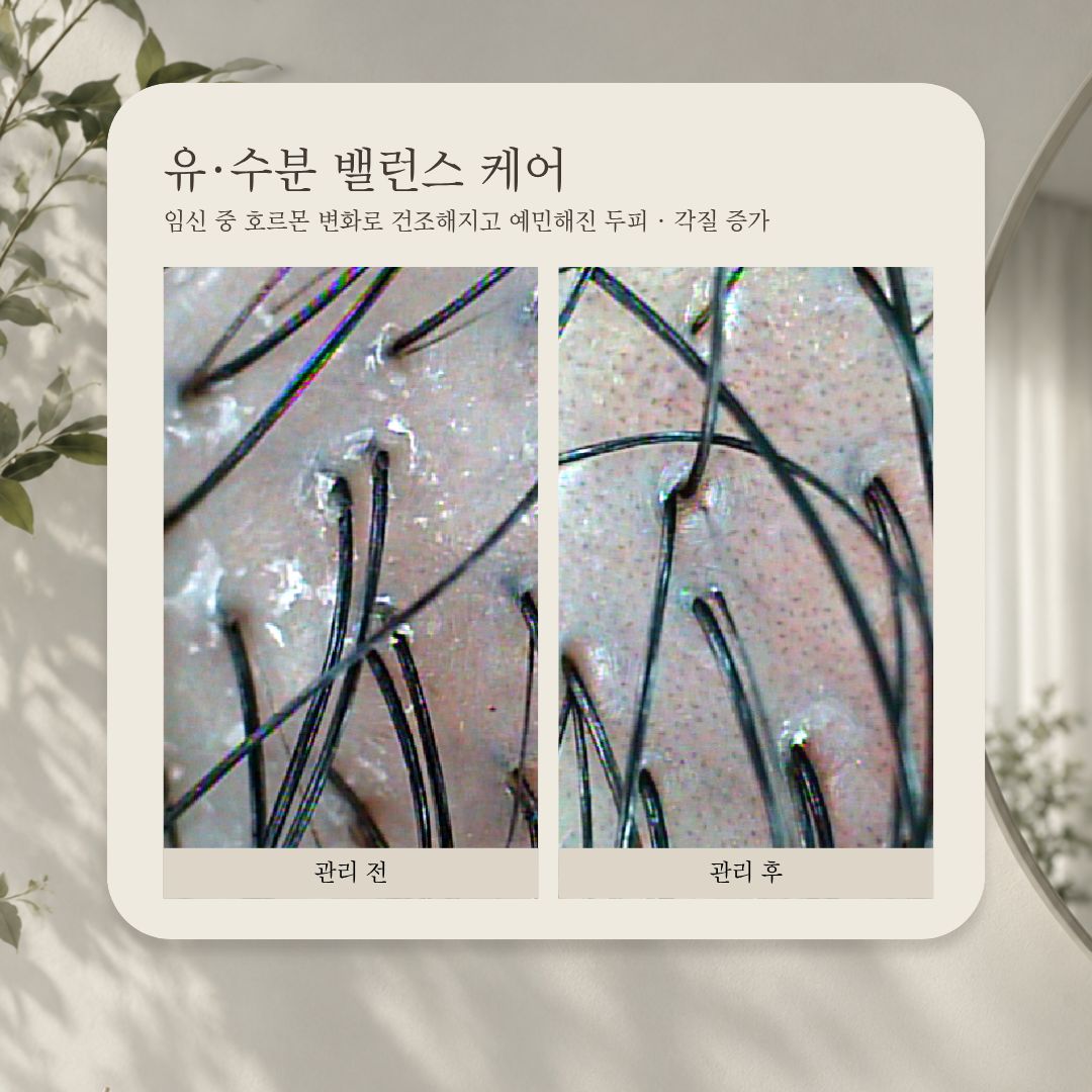 유·수분 밸런스 케어 관리 전·후 비교 사진, 사례 2