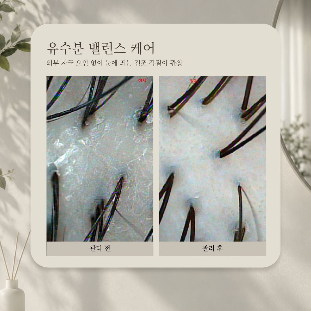 유·수분 밸런스 케어 관리 전·후 비교 사진, 사례 3