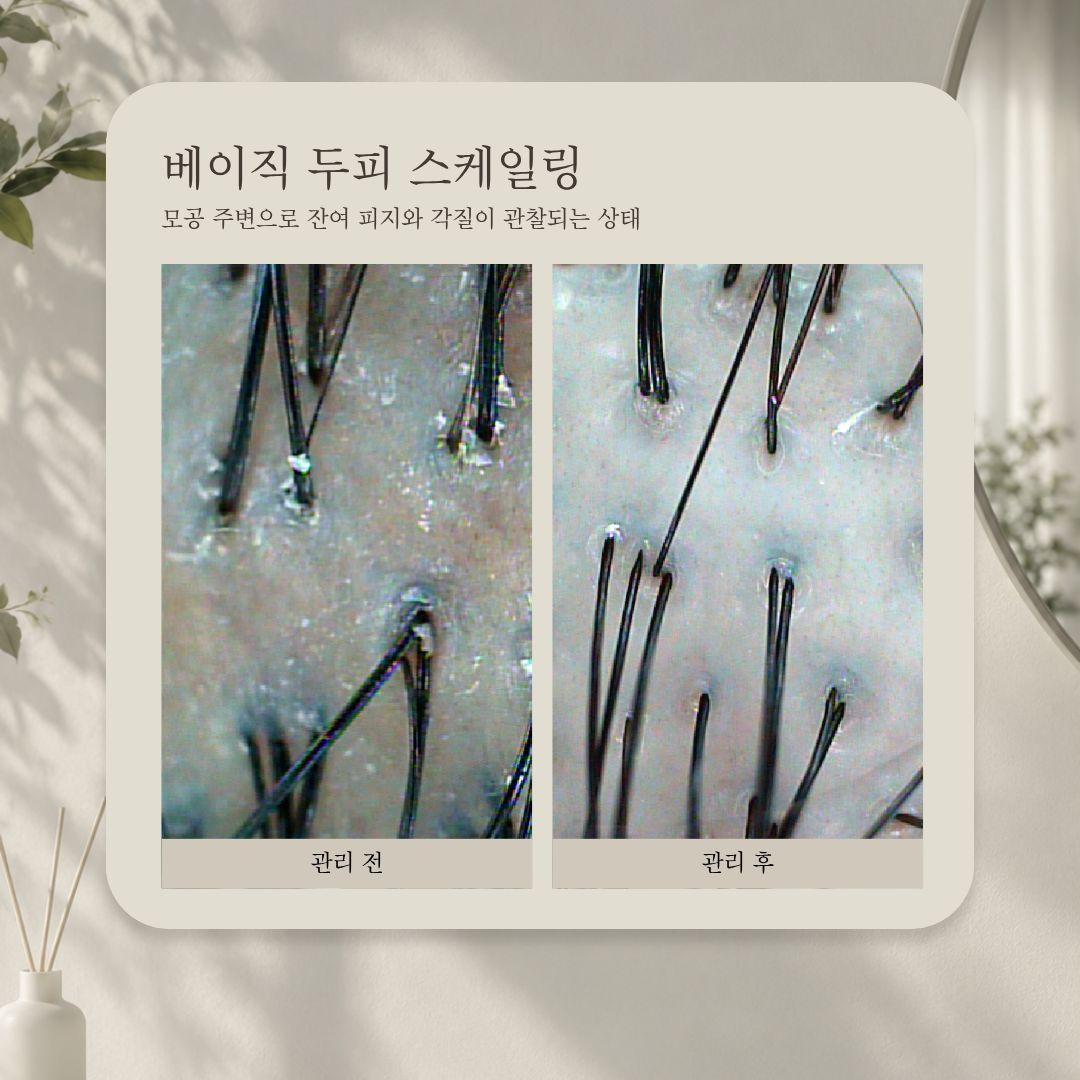 베이직 두피 스케일링 관리 전·후 비교 사진, 사례 1