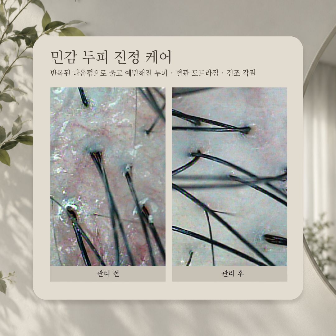 민감 두피 진정 케어 관리 전·후 비교 사진, 사례 4