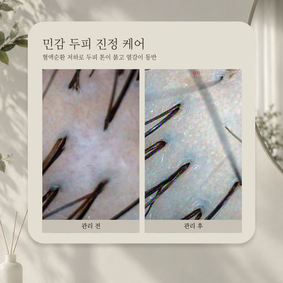 민감 두피 진정 케어 관리 전·후 비교 사진, 사례 5
