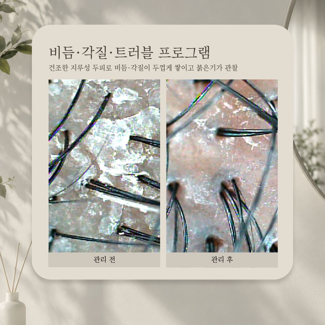 비듬·각질·트러블 프로그램 관리 전·후 비교 사진, 사례 6