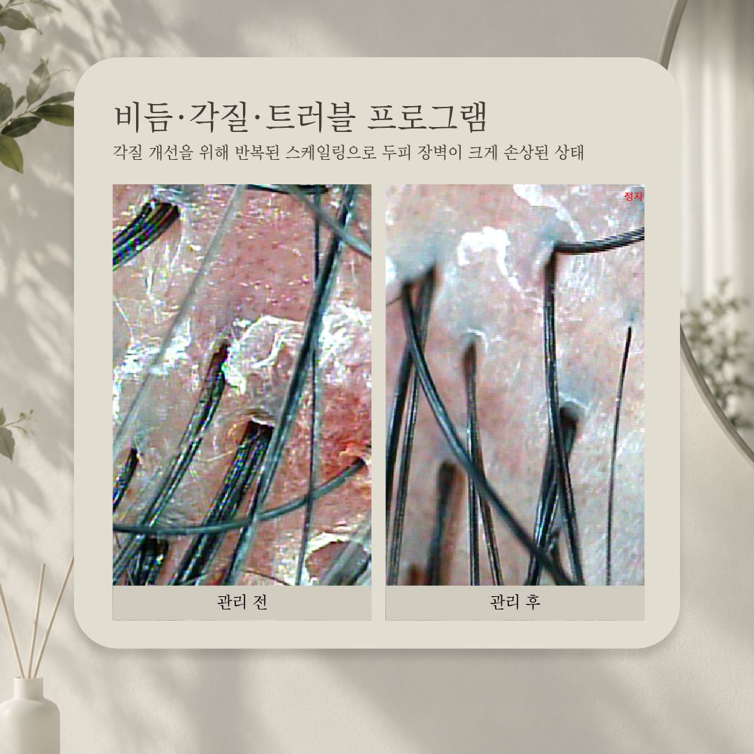 비듬·각질·트러블 프로그램 관리 전·후 비교 사진, 사례 7