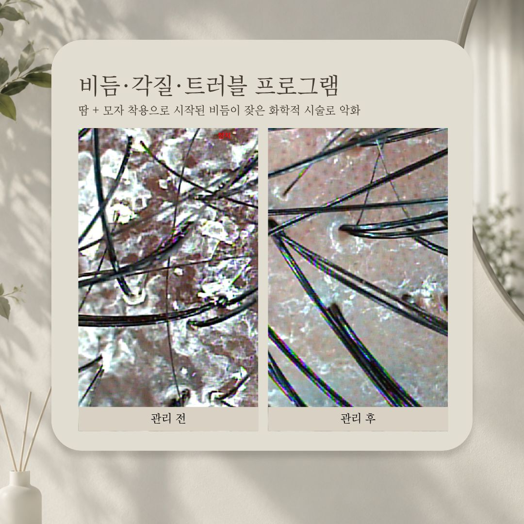 비듬·각질·트러블 프로그램 관리 전·후 비교 사진, 사례 8